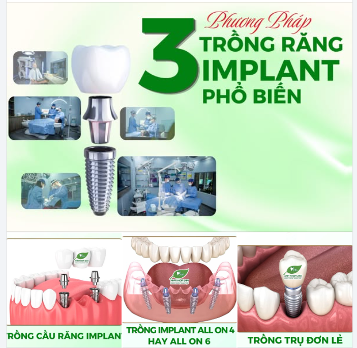 3 PHƯƠNG PHÁP TRỒNG RĂNG IMPLANT PHỔ BIẾN NHẤT HIỆN NAY