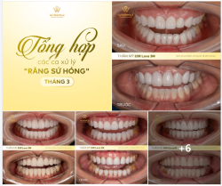 KHÉP LẠI THÁNG 3 BẰNG KẾT QUẢ THÀNH CÔNG CỦA NHỮNG CA SỮA LỖI NỤ CƯỜI “HỎNG”