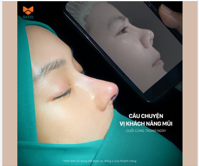 Một ca nâng mũi cuối trong ngày vừa hoàn thành không băng nẹp, không dẫn lưu.