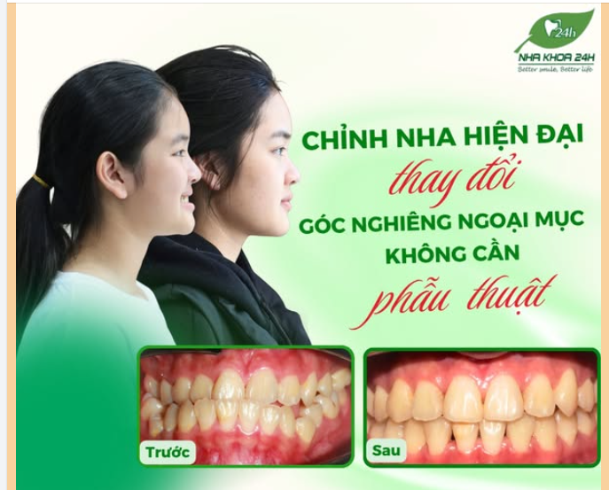 CHỈNH NHA HIỆN ĐẠI – THAY ĐỔI GÓC NGHIÊNG NGOẠI MỤC KHÔNG CẦN PHẪU THUẬT