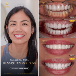 Từ 1 nụ cười đầy miệng, thô dày khiến môi không khép kín, đến đường cong nụ cười hài hòa trọn vẹn là cả hành trình ý nghĩa đối với chị Joyce Celimen.