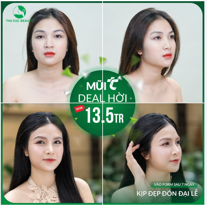 Nâng mũi chuẩn Y khoa - Kịp đẹp đón Đại Lễ