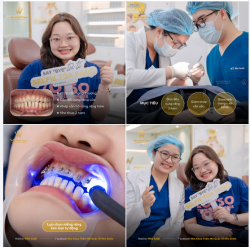 KHÉP KHE THƯA - TÁI LẬP KHỚP CẮN CHUẨN CHO NỤ CƯỜI HÀI HÒA