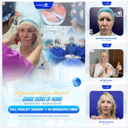 Phẫu thuật căng da mặt toàn phần + Smas nội soi 4K tại Bệnh viện thẩm mỹ Gangwhoo: Tác động sâu - Hiệu quả thật