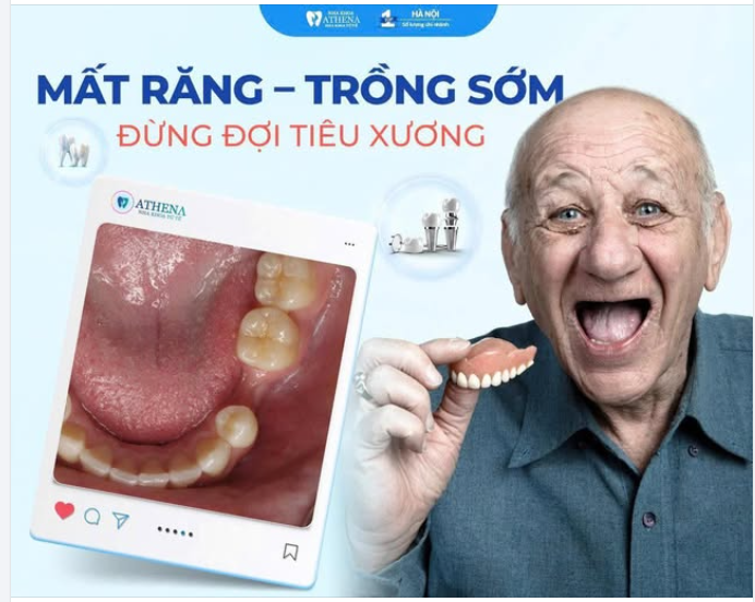 TẠI SAO MẤT RĂNG NÊN TRỒNG SỚM?
