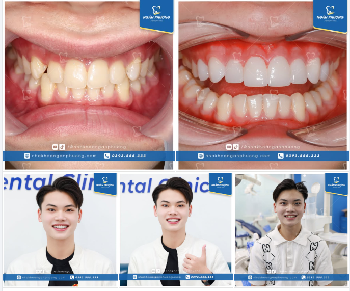 Dán sứ cho chàng trai trẻ Quang Đức