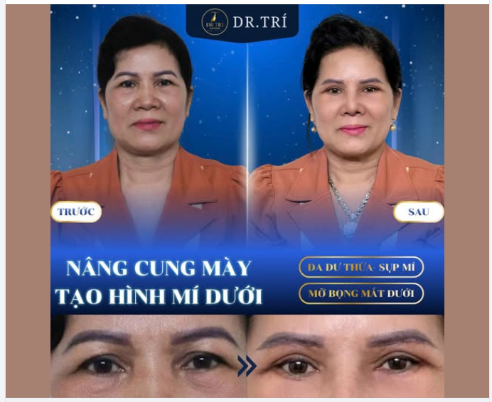 TẠM BIỆT MẮT SỤP - XÓA SẠCH BỌNG MỠ CÙNG DR. TRÍ