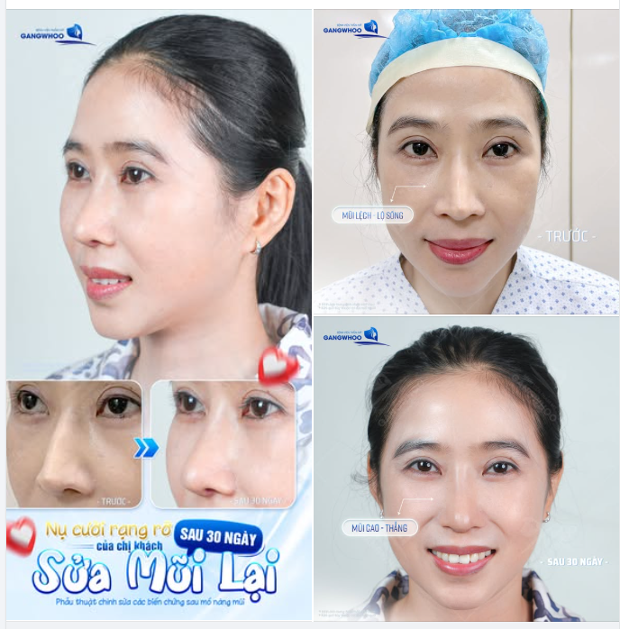 Từng mang nỗi ám ảnh với dáng mũi lỗi, lộ sống, bóng đỏ từ lần phẫu thuật trước, chị khách đã đặt niềm tin vào bác sĩ tại BVTM Gangwhoo.