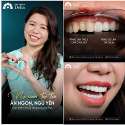 Răng sứ vừa gắn keo đã muốn tháo – Chuyện thật của khách hàng U50 ở Đà Lạt