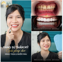 BỌC SỨ THẨM MỸ – GIẢI PHÁP TẠM BIỆT KHE THƯA & CẢI THIỆN RĂNG Ố VÀNG