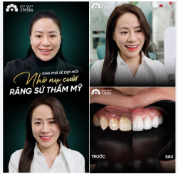 KHAI PHÁ VẺ ĐẸP NHỜ NỤ CƯỜI RĂNG SỨ THẨM MỸ