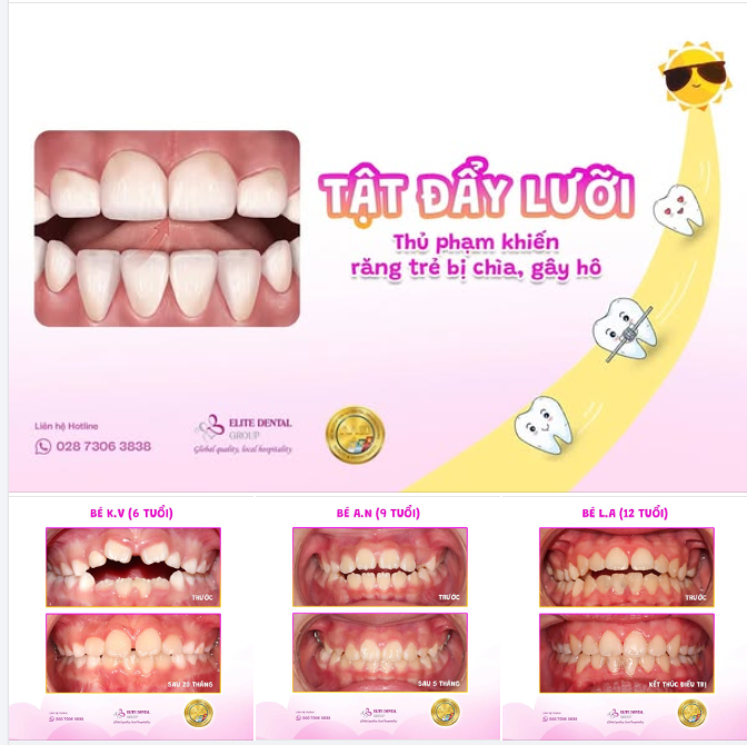 RĂNG HÔ DO TẬT ĐẨY LƯỠI - KHẮC PHỤC KỊP THỜI NHỜ CHỈNH NHA TĂNG TRƯỞNG