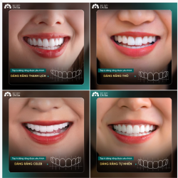 TOP 4 DÁNG RĂNG SỨ ĐƯỢC YÊU THÍCH TẠI DELIA ĐẦU NĂM 2026