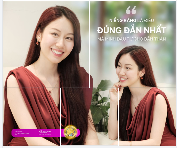 "NIỀNG RĂNG LÀ ĐIỀU ĐÚNG ĐẮN NHẤT MÀ MÌNH ĐÃ ĐẦU TƯ CHO BẢN THÂN"