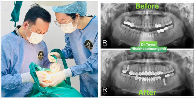 Các bước chuẩn bị trước khi cấy ghép Implant