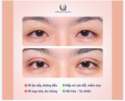 SỰ THAY ĐỔI NGOẠN MỤC: TỪ 1 MÍ THÀNH 2 MÍ CÂN ĐỐI