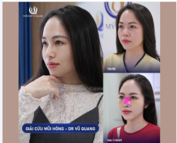 60 PHÚT – SỞ HỮU DÁNG MŨI CHUẨN TỶ LỆ VÀNG