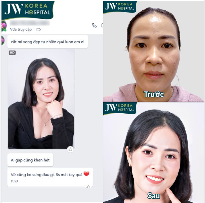 CHỊ KHÁCH 8X CỰC ƯNG ĐÔI MẮT MỚI SAU CẮT MẮT TẠI JW