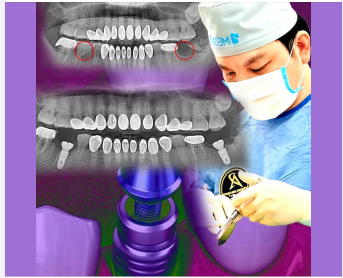 Vật liệu làm implant nha khoa từ gì? có an toàn không?
