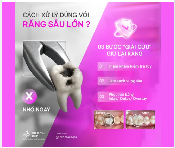 NHỔ BỎ HAY "GIẢI CỨU" RĂNG SÂU LỚN