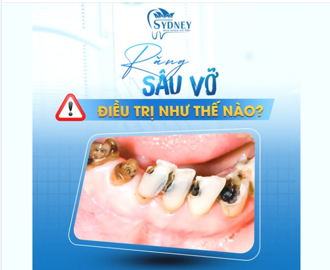 RĂNG SÂU VỠ ĐIỀU TRỊ NHƯ THẾ NÀO?