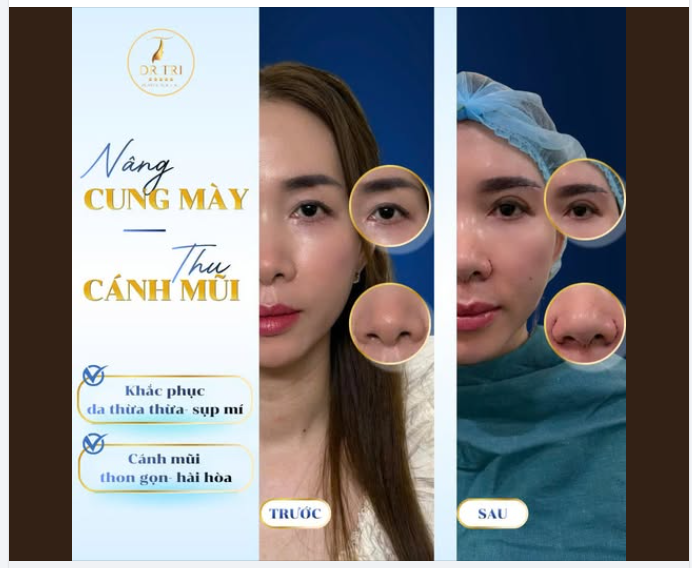 CẬN CẢNH KẾT QUẢ NGAY SAU KHI THỰC HIỆN COMBO NÂNG CUNG MÀY- THU CÁNH MŨI TẠI DR. TRÍ