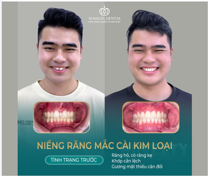 MỪNG NGÀY THÁO NIỀNG: KHÁCH HÀNG NGUYỄN HỮU VINH