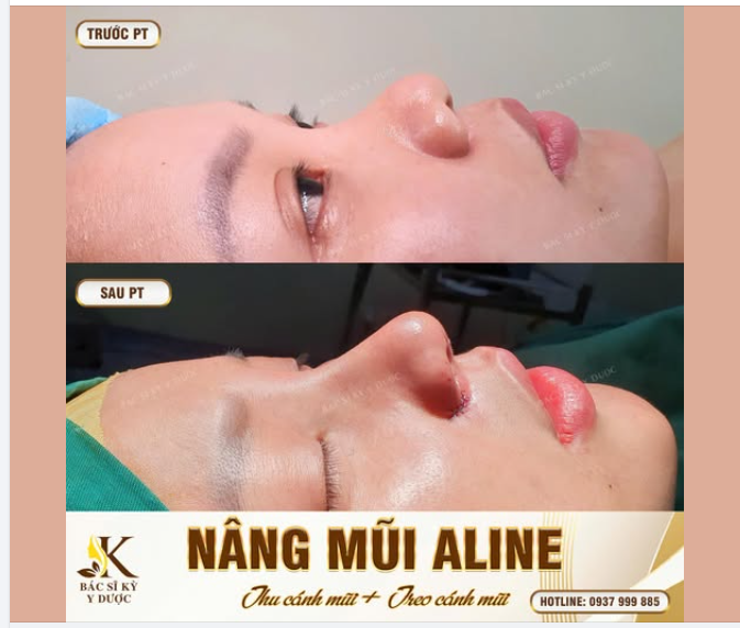 NÂNG MŨI ALINE - KIẾN TẠO GÓC NGHIÊNG "TỈ LỆ VÀNG"