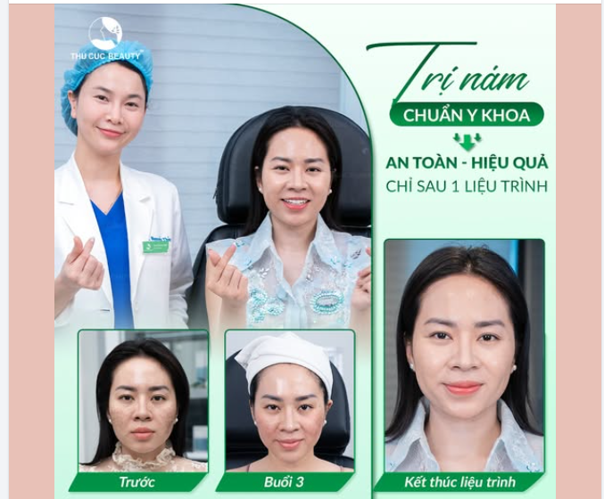 Trước: che khuyết điểm 3 lớp vẫn thấy nám