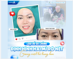 LOẠI BỎ DA CHÙNG MÍ MẮT - GƯƠNG MẶT TRẺ TRUNG HƠN