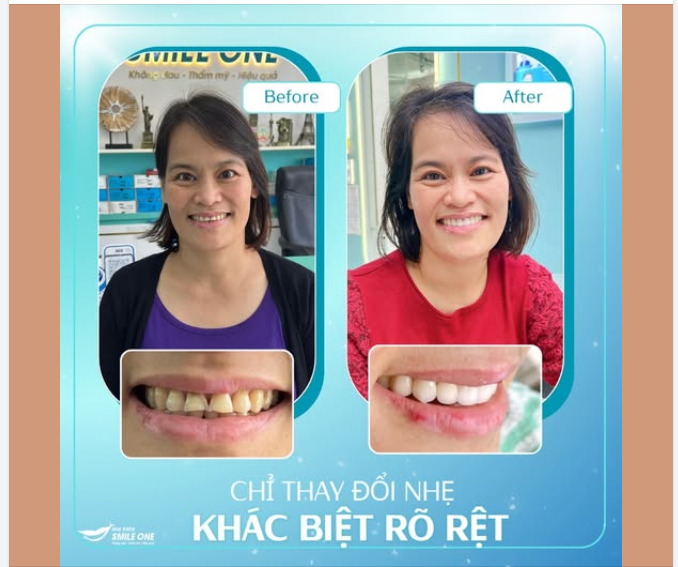 CHỈ THAY ĐỔI NHẸ – NHƯNG KHÁC BIỆT RÕ RỆT TRONG NỤ CƯỜI