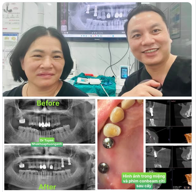 Case Implant nhổ cấy tức thì cho chị đồng nghiệp sau ca trực đêm. Hình ảnh đẹp như sách