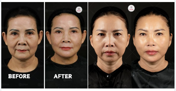 FILLER MD CODES CÓ S.ƯNG B.ẦM KHÔNG?