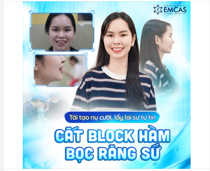 DIỆN MẠO KHÁC LẠ HOÀN TOÀN SAU CẮT BLOCK HÀM, BỌC RĂNG SỨ