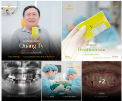 CÙNG LÀ TRỒNG RĂNG IMPLANT, NHƯNG LÀM Ở WIN SMILE KHÁC LẮM!
