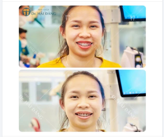 NIỀNG RĂNG KẾT HỢP CẮT LỢI – LỘ DIỆN NỤ CƯỜI XINH XẮN SAU THỜI GIAN ĐIỀU TRỊ