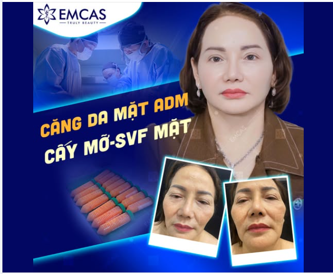 CĂNG DA MẶT - TREO CUNG MÀY - CẤY MỠ TOÀN MẶT