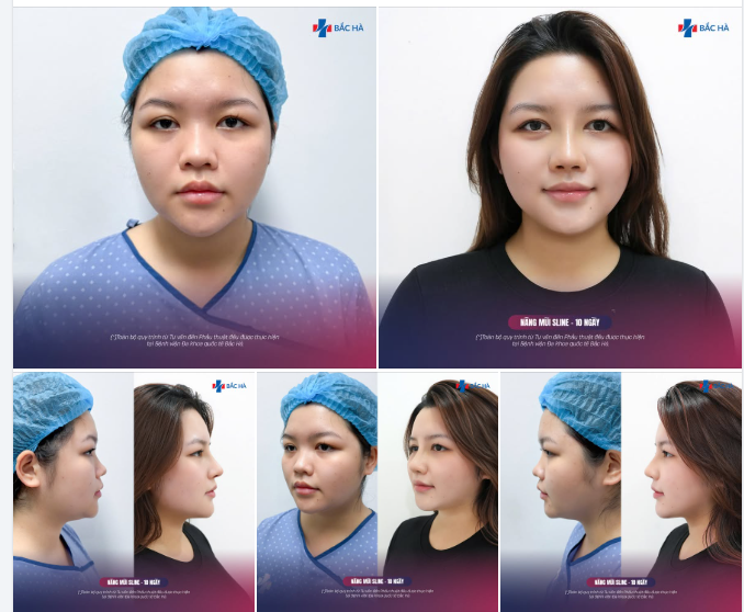 10 NGÀY SAU NÂNG MŨI – KHI KHÁCH HÀNG QUAY LẠI VỚI SỰ HÀI LÒNG RÕ RỆT