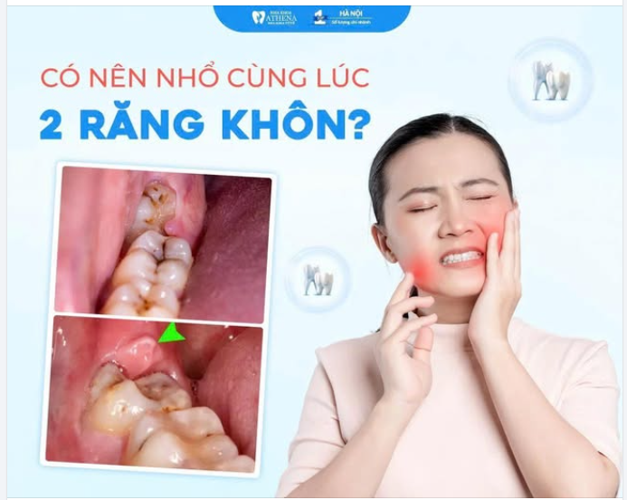 NHỔ 2 RĂNG KHÔN CÙNG LÚC NÊN HAY KHÔNG?