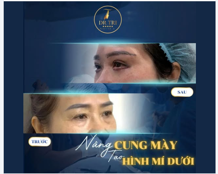 ĐÁNH BAY SỤP MÍ VÀ BỌNG MỠ CHỈ SAU 1 LÀM TẠI DR. TRÍ