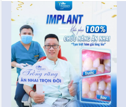 IMPLANT KHÔI PHỤC 100% CHỨC NĂNG NHAI: TẠM BIỆT HÀM GIẢ LỎNG LẺO