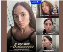 6 tháng – không chỉ là khoảng thời gian hồi phục… Mà là hành trình lột xác nhan sắc và lấy lại sự tự tin đã từng đánh mất