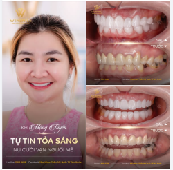 Nụ cười "vạn người mê" bắt đầu từ hàm răng khỏe mạnh!
