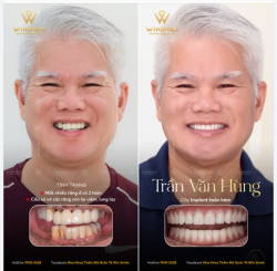 BÍ KÍP DUY TRÌ PHONG ĐỘ U70: TÌM LẠI HÀM RĂNG ĂN NHAI CHẮC KHỎE
