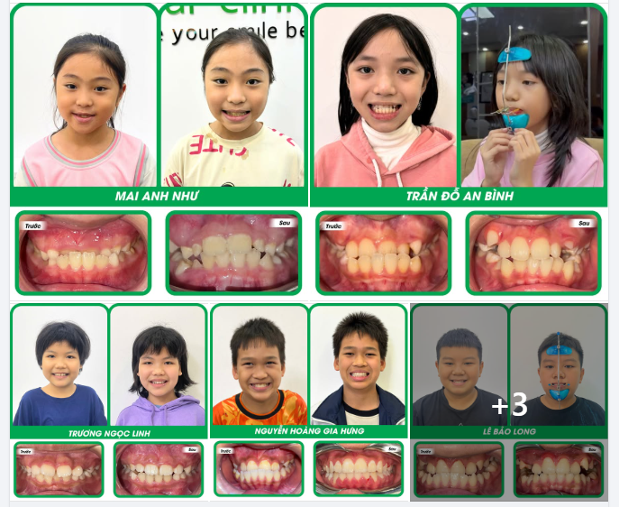 Chi phí chỉnh nha cho trẻ cần được nhìn nhận như một khoản đầu tư y khoa có giá trị lâu dài.