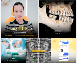 SỢ ĐAU SUỐT NHIỀU NĂM NHƯNG LẦN ĐẦU TRỒNG IMPLANT LẠI NHẸ NHÀNG ĐẾN BẤT NGỜ
