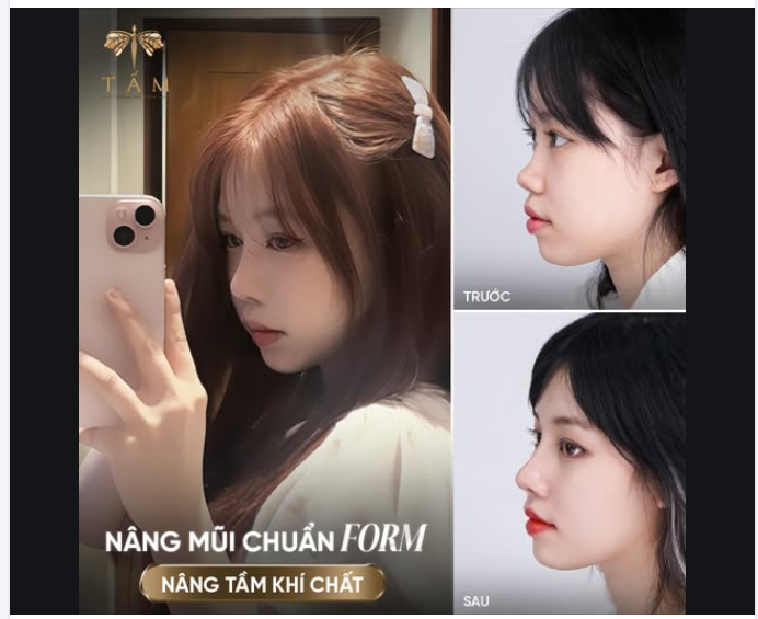 NÂNG MŨI CHUẨN FORM - NÂNG TẦM KHÍ CHẤT