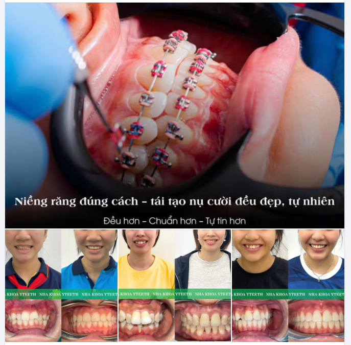 LÀM THẾ NÀO KHI RĂNG LỆCH LẠC, SAI KHỚP CẮN?