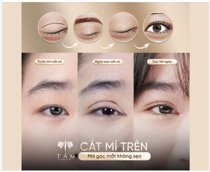 Giải pháp cho mắt nhỏ – mí ẩn – góc mắt hẹp