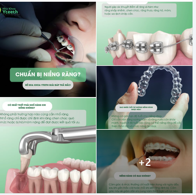 Nha khoa Yteeth giúp bạn gỡ rối mọi thắc mắc trước khi bắt đầu niềng răng